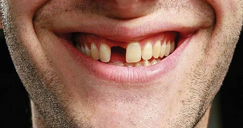 Nằm mơ gãy răng cửa